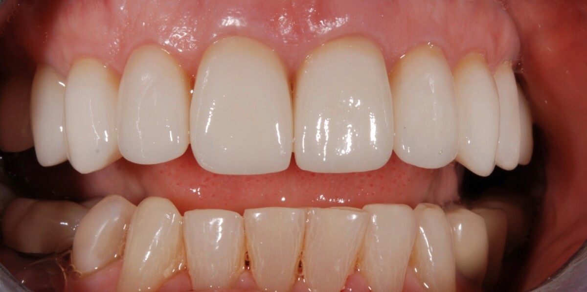 Before & After Porcelain Crowns and Veneers Newcastle Dental