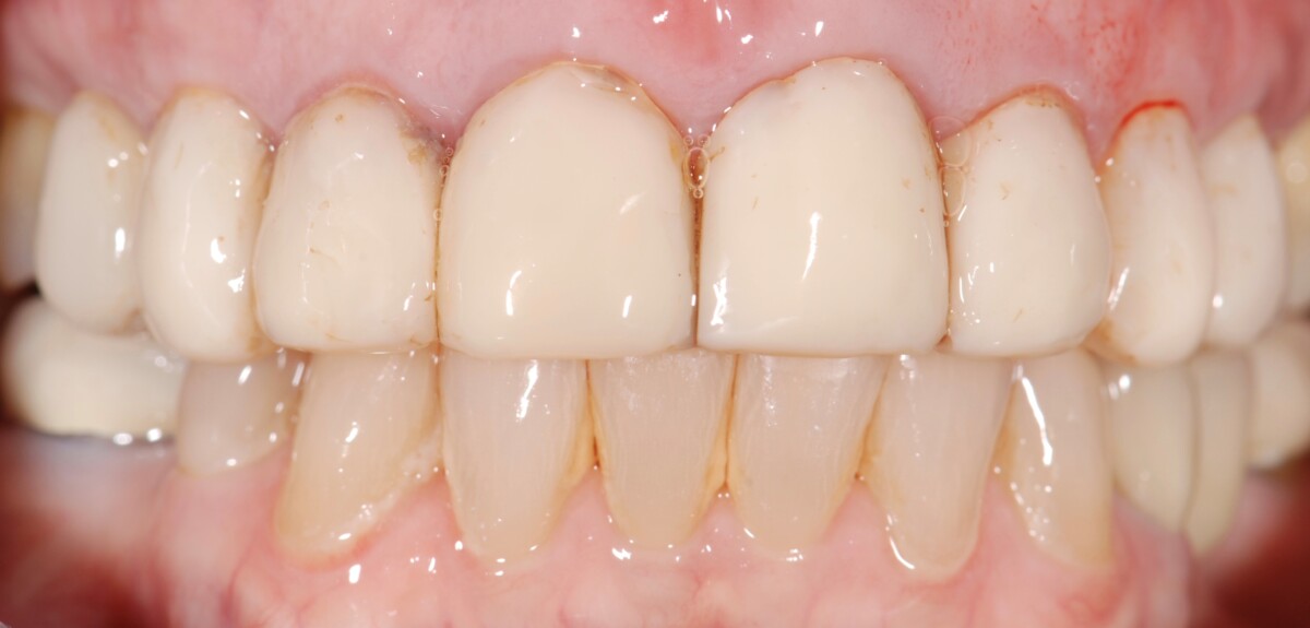 Before & After Porcelain Crowns and Veneers Newcastle Dental